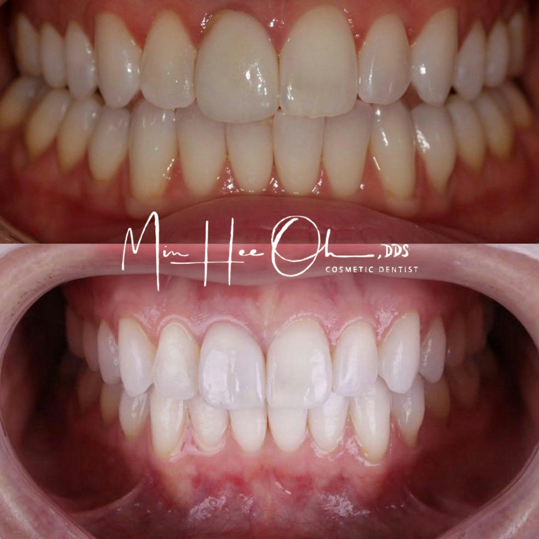 Before and after brighter smile after dental care at Oh Aesthetic Dentistry