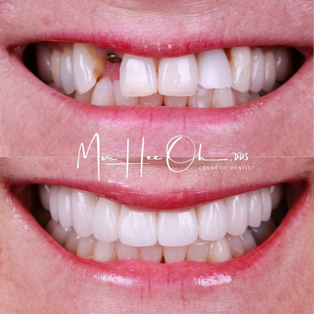 Before and after smile makeover replacing a missing tooth by Dr. Min Hee Oh