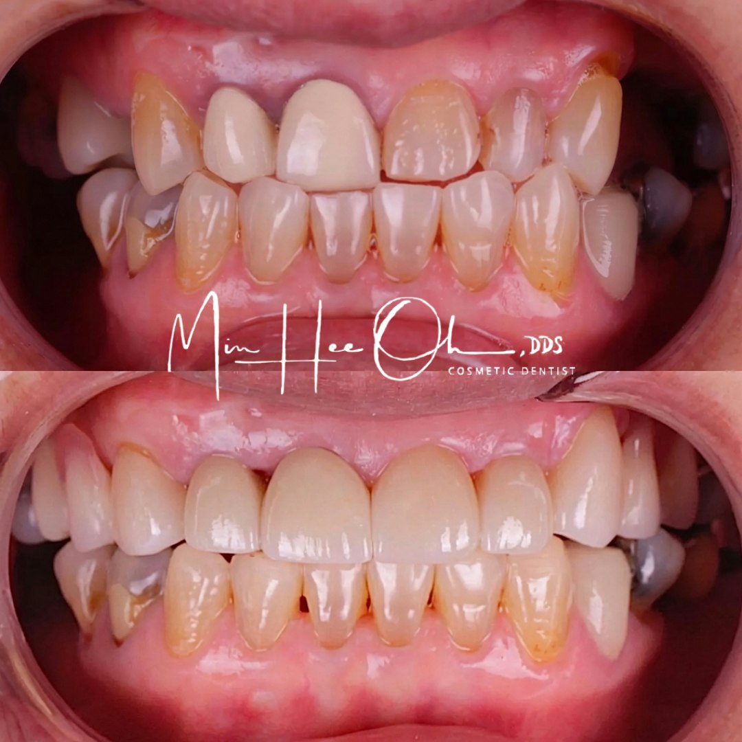 Before and after porcelain veneers covering stained upper front teeth by Dr. Min Hee Oh
