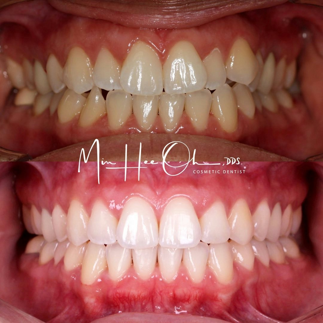Before and after brighter, more even smile by Dr. Min Hee Oh