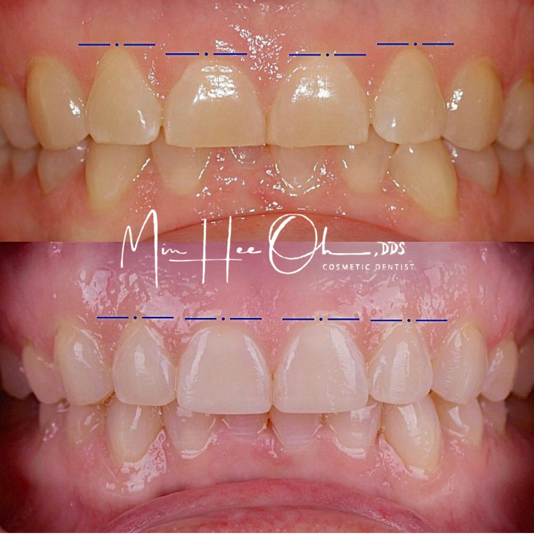 Before and after gum contouring and smile refinement by Dr. Min Hee Oh